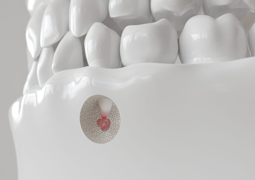 root tip inflammation with apicectomy 3d rendering
