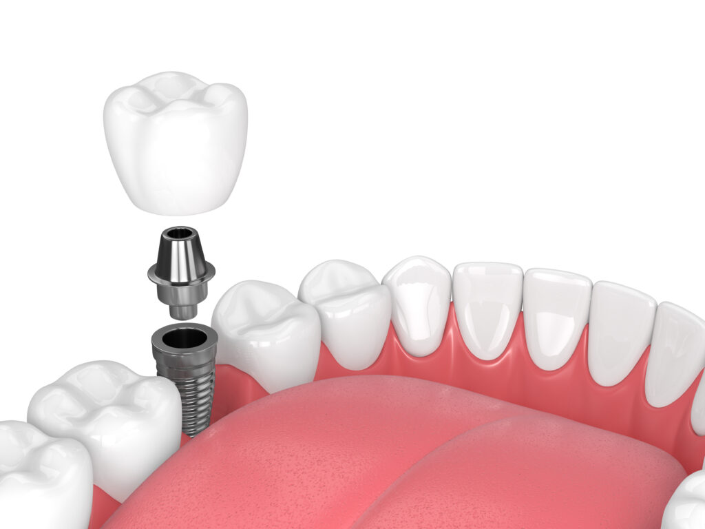 3d render of jaw with teeth and dental molar implant
