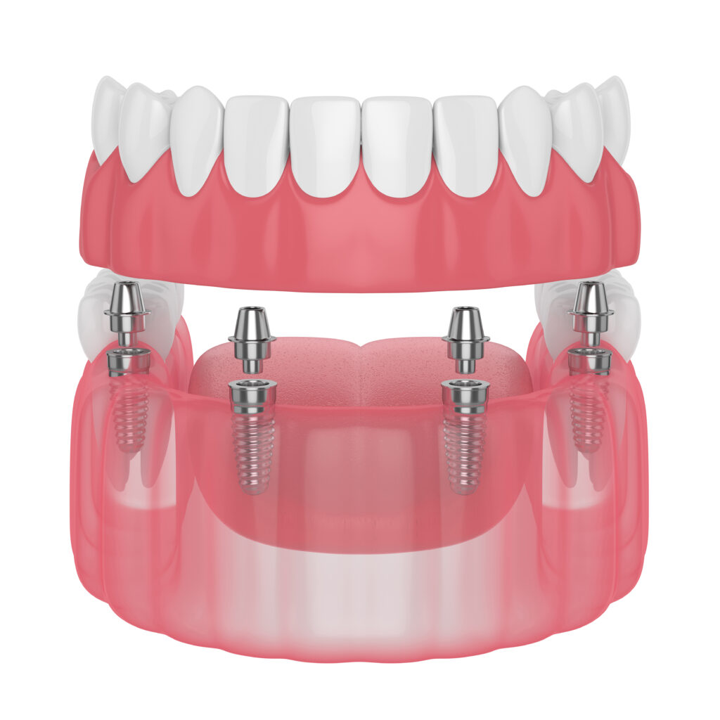3d render of implant partial denture