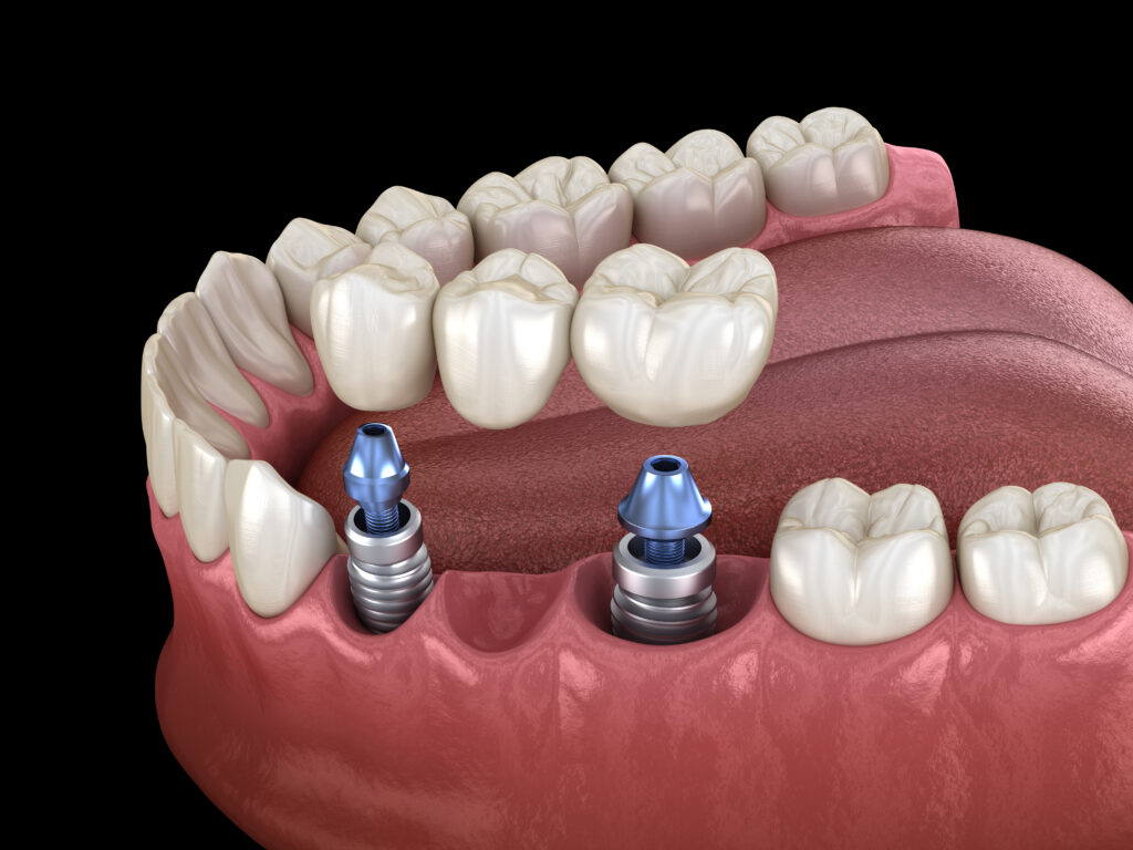 implantat zahnbruecke