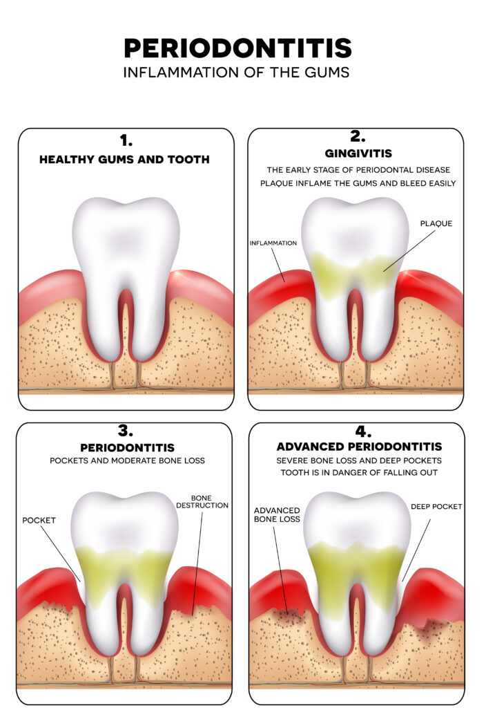 periodontitis