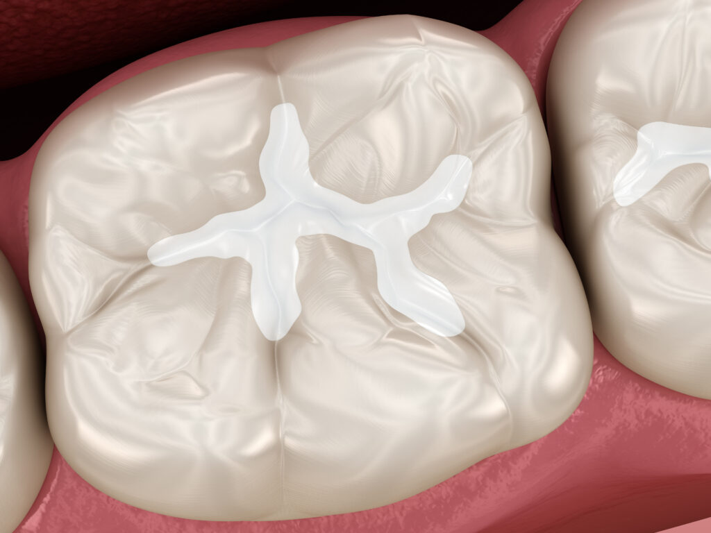 molar tooth restoration with filling. medically accurate tooth 3d illustration.